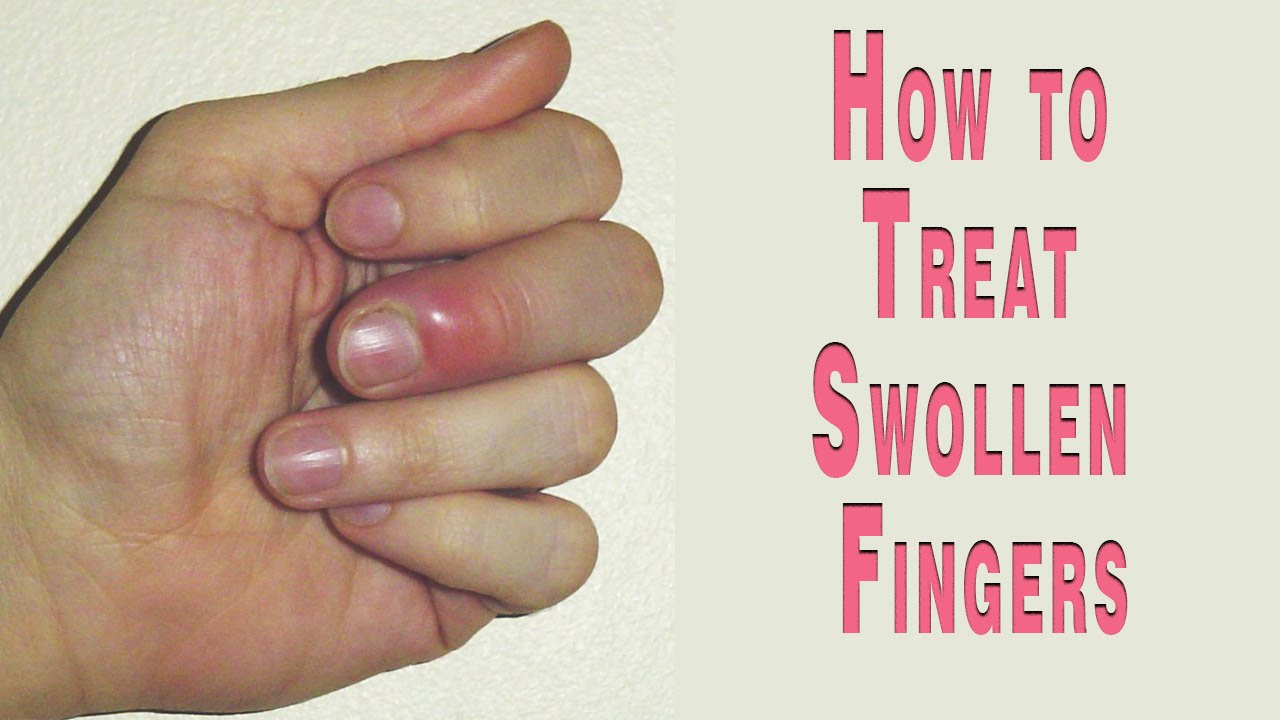 Home Remedy to Reduce Swelling of Hand/Fingers