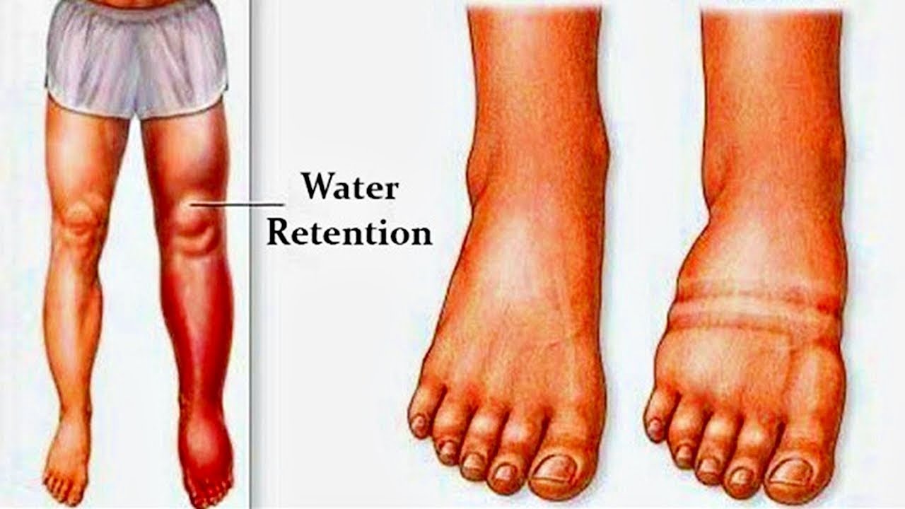 How to Reduce Swelling in Feet/Knees/Legs quickly?