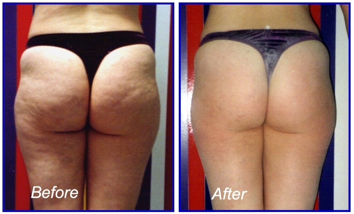 Cellulite Exercise Before and After