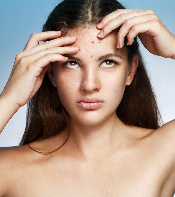 How to Get Rid of Pimples on Forehead?