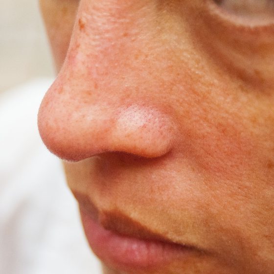 How to Get Rid of Redness Around Nose?