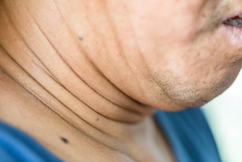 How to Reduce Neck Fats