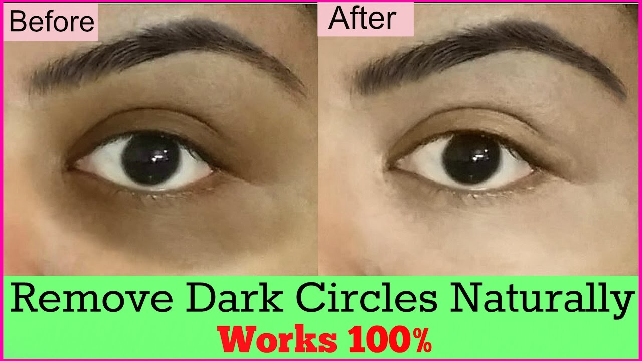 How to Remove Dark Circles