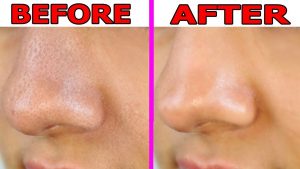 How to Reduce Pore Size On Nose 