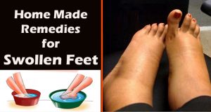 How to Reduce Foot Swelling During Pregnancy