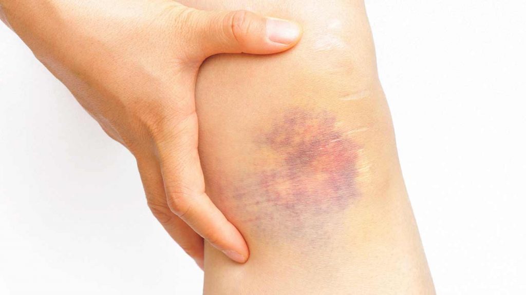 How To Get Rid Of Bruising