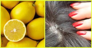 How To Get Rid of Dandruff With Lemon