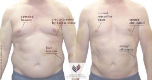 Way to Reduce Chest Fat Naturally