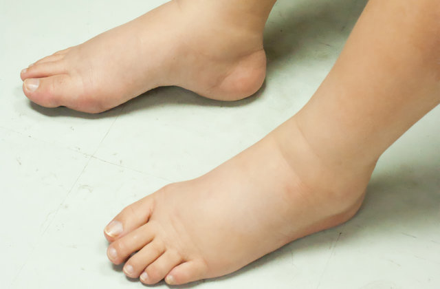 Way to Reduce Foot Swelling with Magnesium supplements