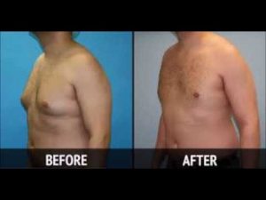 How to Reduce Chest Fat for Male