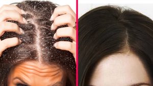 Method to Get Rid of Dandruff in One Wash Instantly