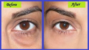 How to Get Rid of Bags Under Eyes Home Remedies