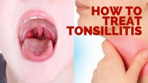 How to Get Rid of Swollen Tonsils Fast