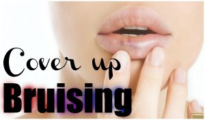 How To Get Rid Of Bruising On Lips Faster