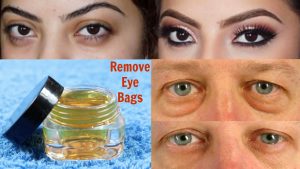 How to Reduce Eye Bags Naturally