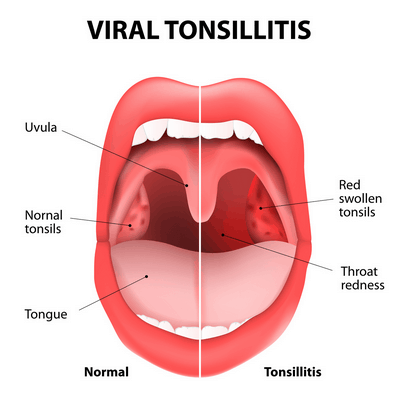How to Reduce Tonsil Swelling