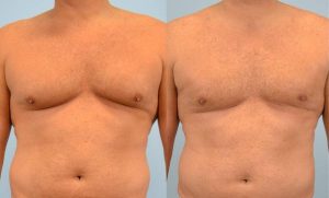 How to Reduce Chest Fat in a Week